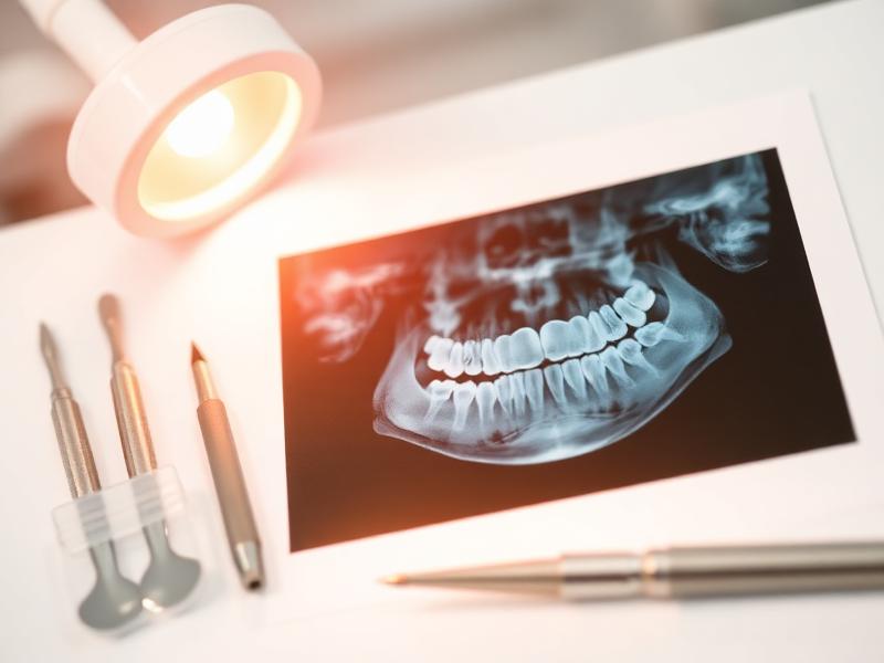 Root Canal Therapy